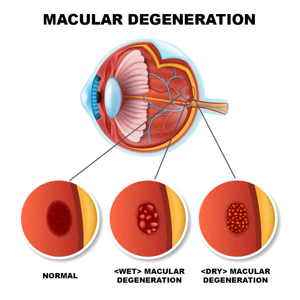 macular_deg macular_deg